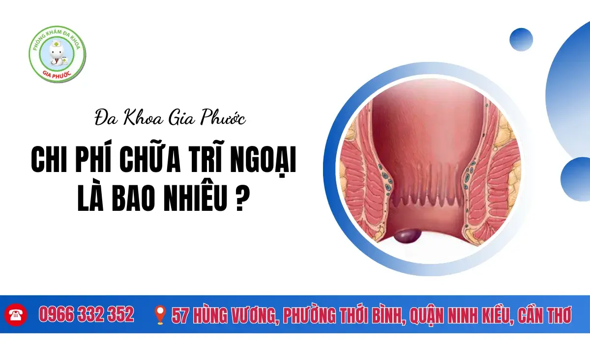 Chi Phí Chữa Trĩ Ngoại Là Bao Nhiêu?