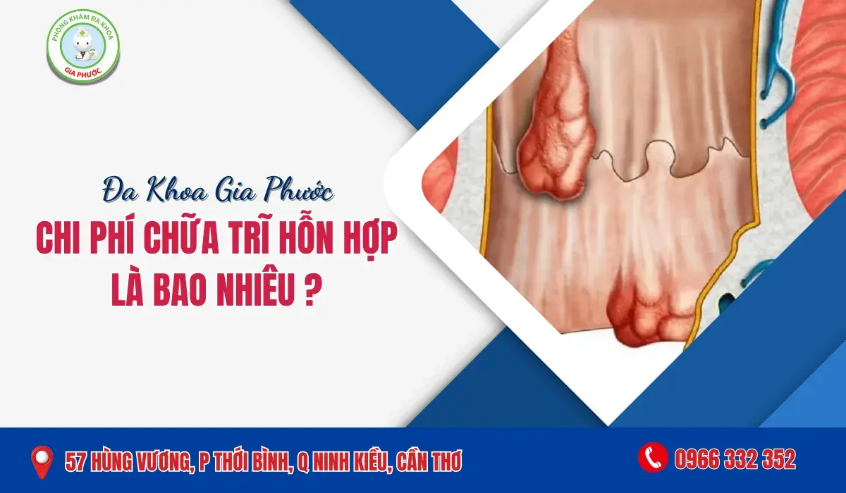 Chi Phí Chữa Trĩ Hỗn Hợp Là Bao Nhiêu?