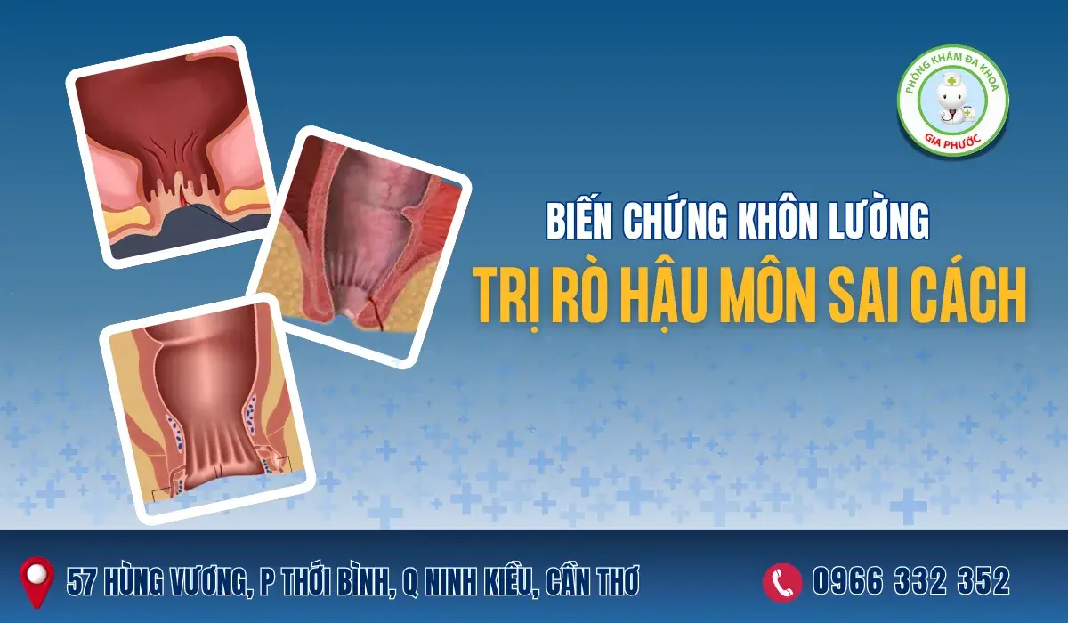 Biến Chứng Khôn Lường Khi Trị Rò Hậu Môn Sai Cách